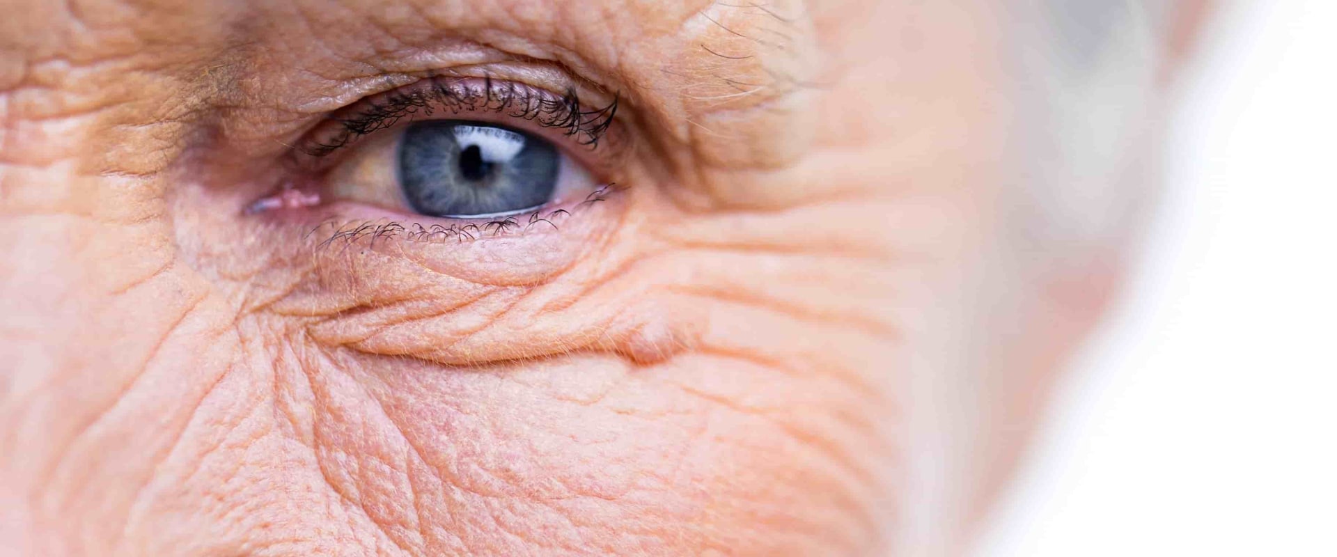 Understanding the Restrictions After Cataract Surgery