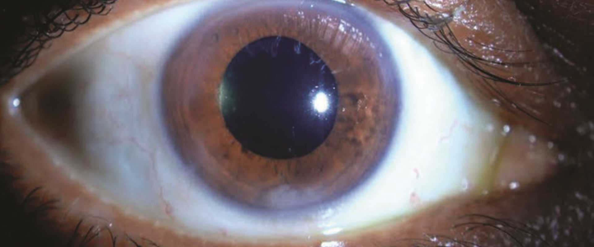 What to Know About the Recovery Period After Cataract Surgery