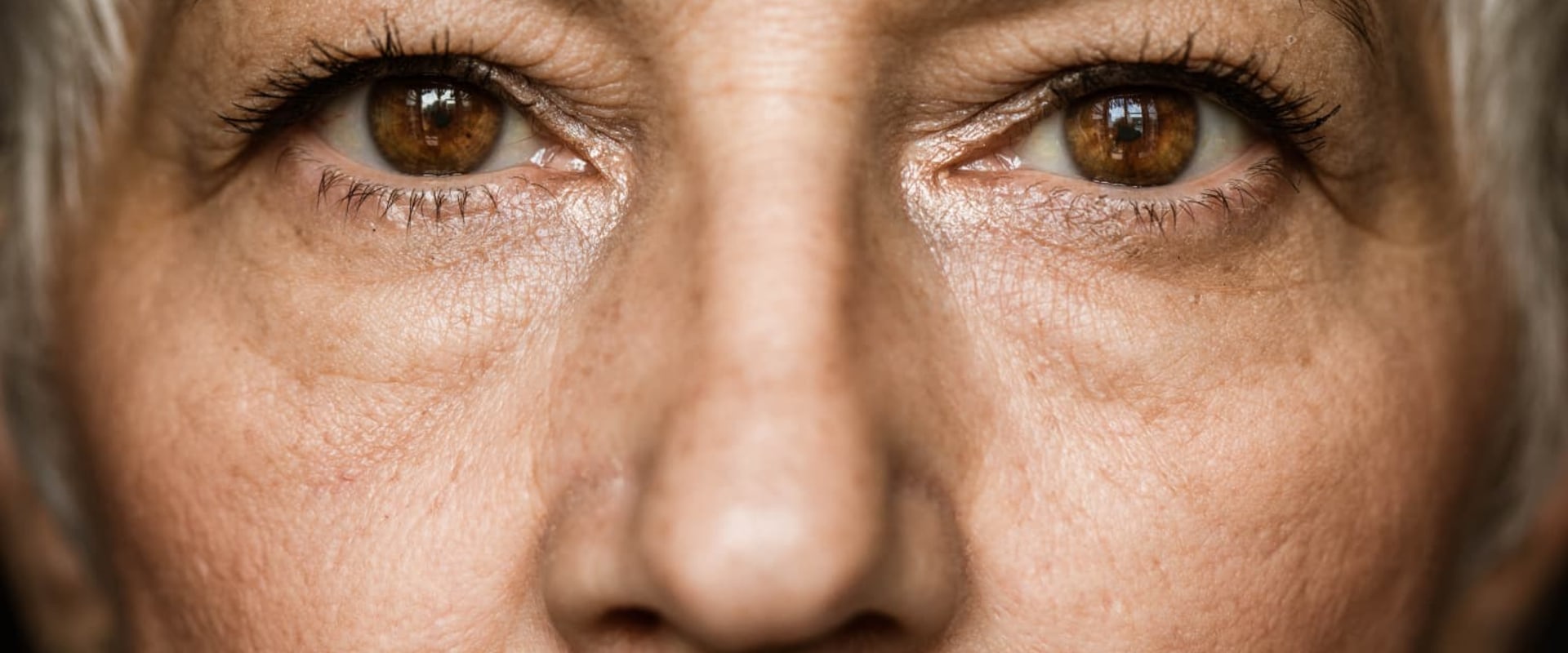 Will Vision Be the Same in Both Eyes After Cataract Surgery?