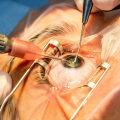 The Latest Advances in Cataract Surgery: What You Need to Know