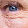 What are the Risks of Bending Over After Cataract Surgery?