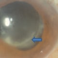 How Long After Cataract Surgery Can Endophthalmitis Occur?