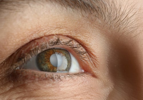 When is the Right Time to Get Cataract Surgery?