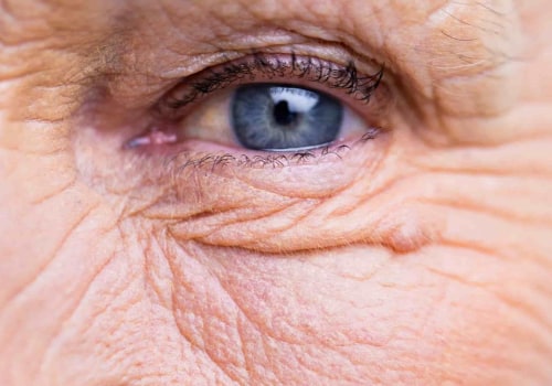 Understanding the Restrictions After Cataract Surgery