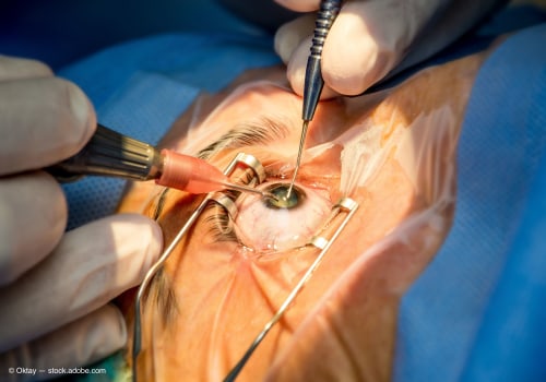 The Latest and Most Advanced Method for Cataract Surgery