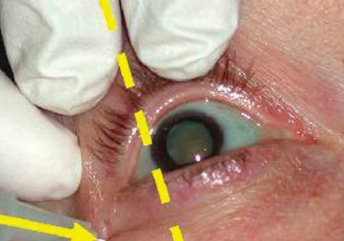 What Are the Risks of Doing Too Much After Cataract Surgery?