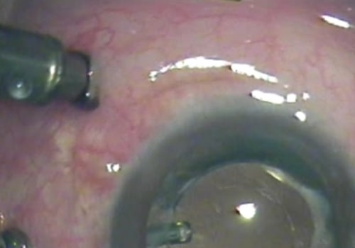 What Are the Risks and Complications of Cataract Surgery?