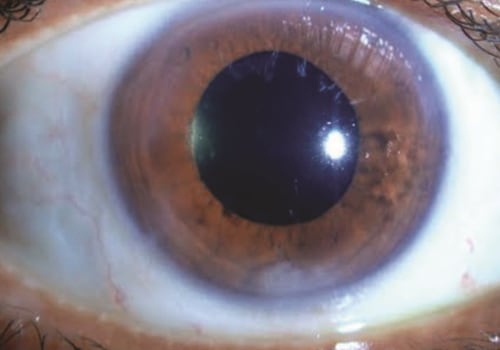 What to Know About the Recovery Period After Cataract Surgery