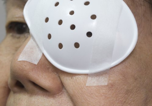 How Many Days of Rest is Needed After Cataract Surgery?