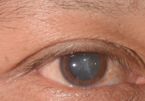 What Are the Risks of Doing Too Much After Cataract Surgery?