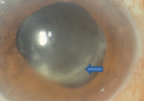 How Long After Cataract Surgery Can Endophthalmitis Occur?