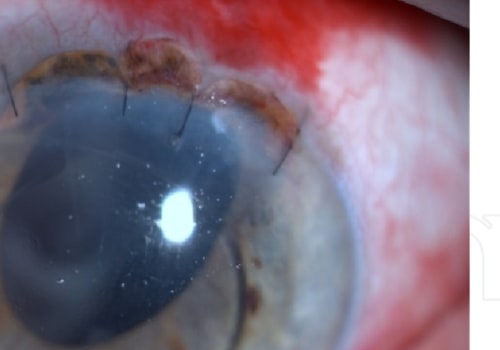 What Are the Complications of Cataract Surgery?