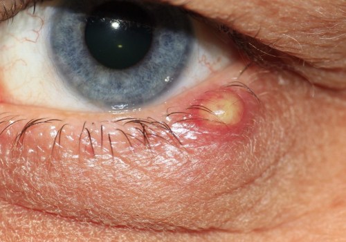 What Are the Signs of an Eye Infection After Cataract Surgery?